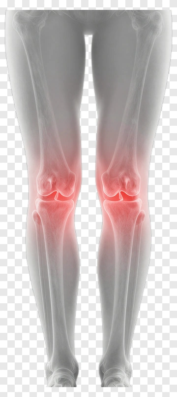 Knee Joint X-Ray With Highlighted Pain Areas PNG