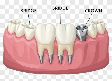 Dental Bridge And Crown Diagram PNG